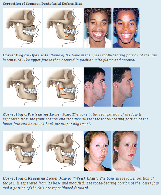 Oral Surgery Jaw 71